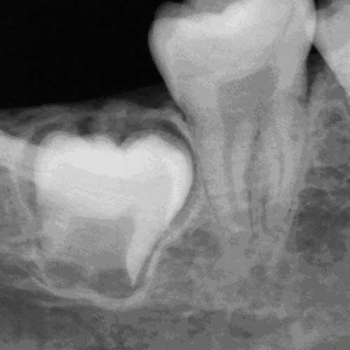 All About Third Molars